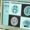 El Hospital Clínic confirma que una analítica de sangre permite diagnosticar el alzheimer