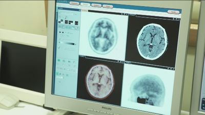 El Hospital Clínic confirma que una analítica de sangre permite diagnosticar el alzheimer