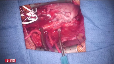 Aumentan en 2021 un 8% los trasplantes realizados con respecto a 2020