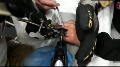 Impresiona verlo... y oírlo: bomberos de Alcorcón cortan un anillo atascado a una joven