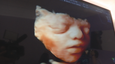 Ecografías en 5D, la imagen más realista que se puede obtener del bebé antes del parto