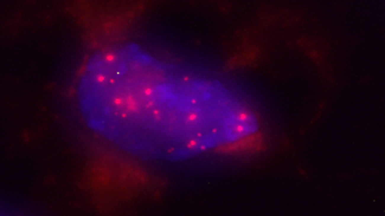 Núcleo de una célula pancreática, en color azul, en el que se observan Bacteroides, en rojo, uno de los microorganismos identificados en el trabajo.