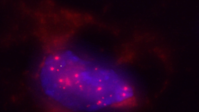 Un análisis de heces puede diagnosticar de manera temprana el cáncer de páncreas