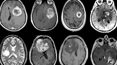 Logran eliminar por primera vez el cáncer cerebral más agresivo, el glioblastoma