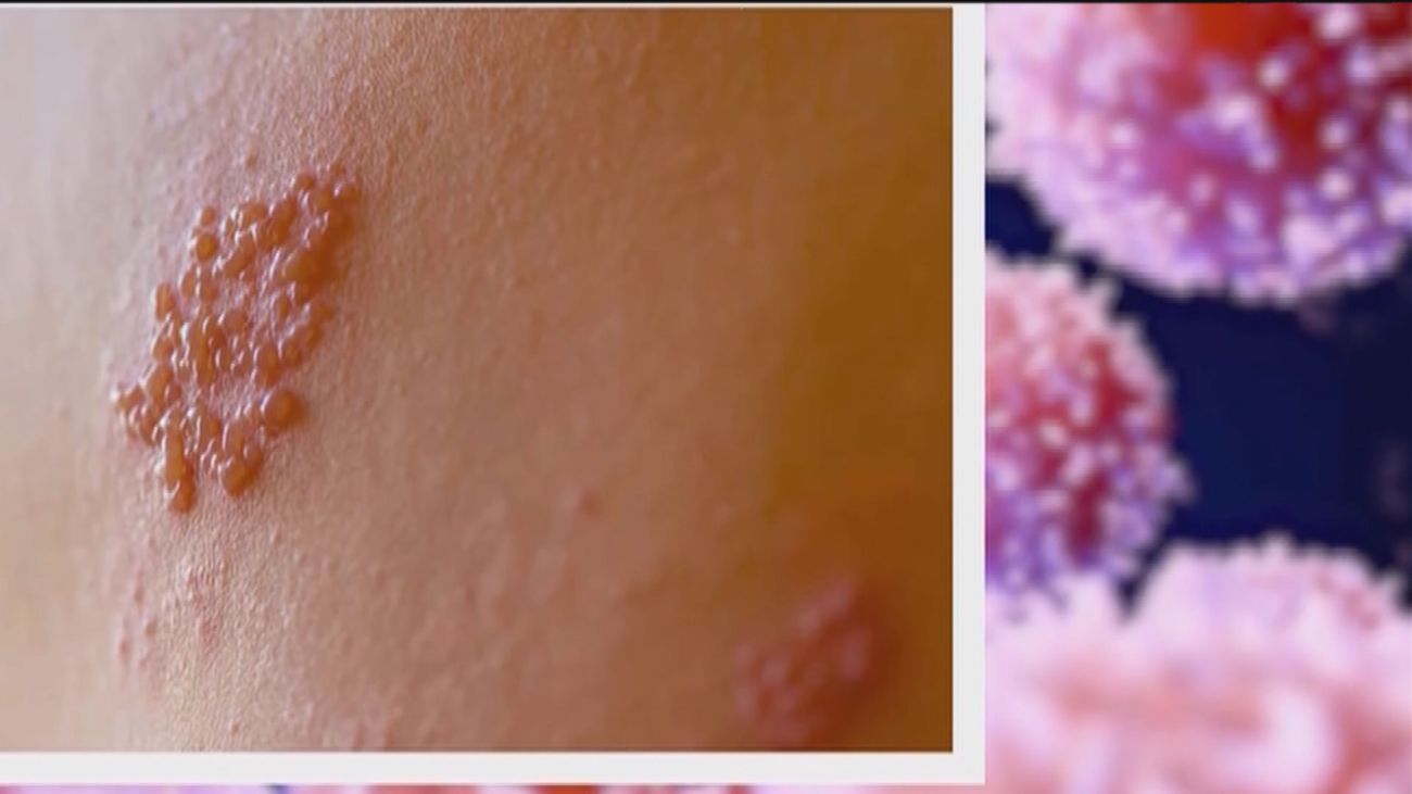 Madrid vacunará desde mayo contra el herpes zóster a mayores de 65 y 80 años