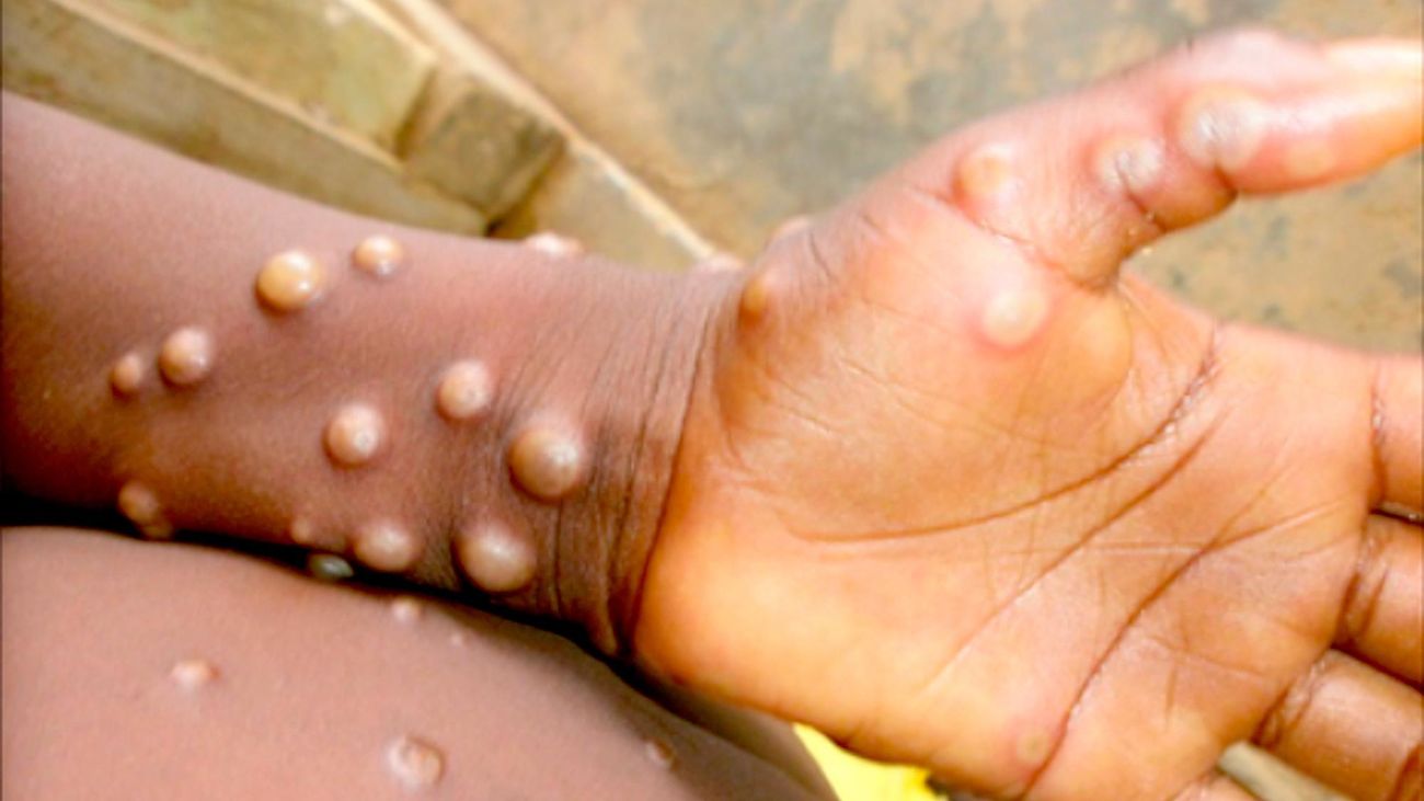 Qué es la viruela del mono: síntomas, cómo se transmite y cuál es su origen