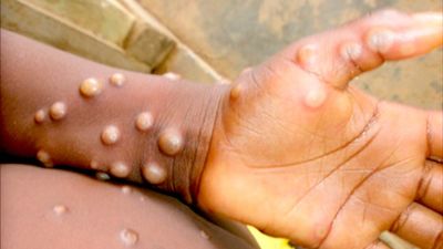 Qué es la viruela del mono: síntomas, cómo se transmite y cuál es su origen