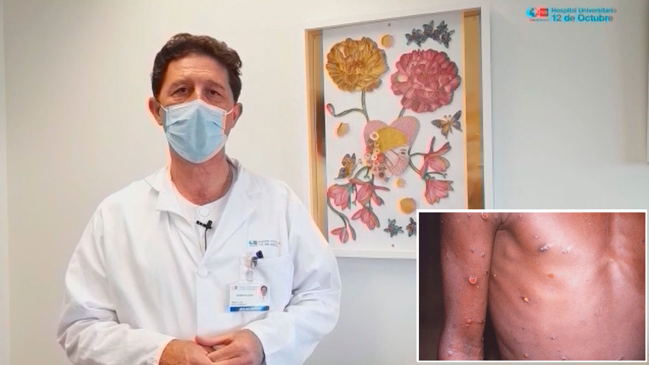 ¿Cómo sé si estoy infectado con viruela del mono? Así lo podemos detectar y así debemos actuar