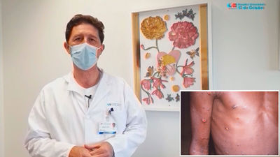 ¿Cómo sé si estoy infectado con viruela del mono? Así lo podemos detectar y así debemos actuar