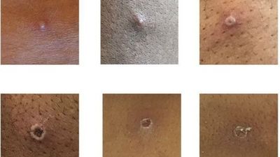 Viruela del mono: Madrid actualiza las cifras con 34 casos confirmados y 38 sospechosos