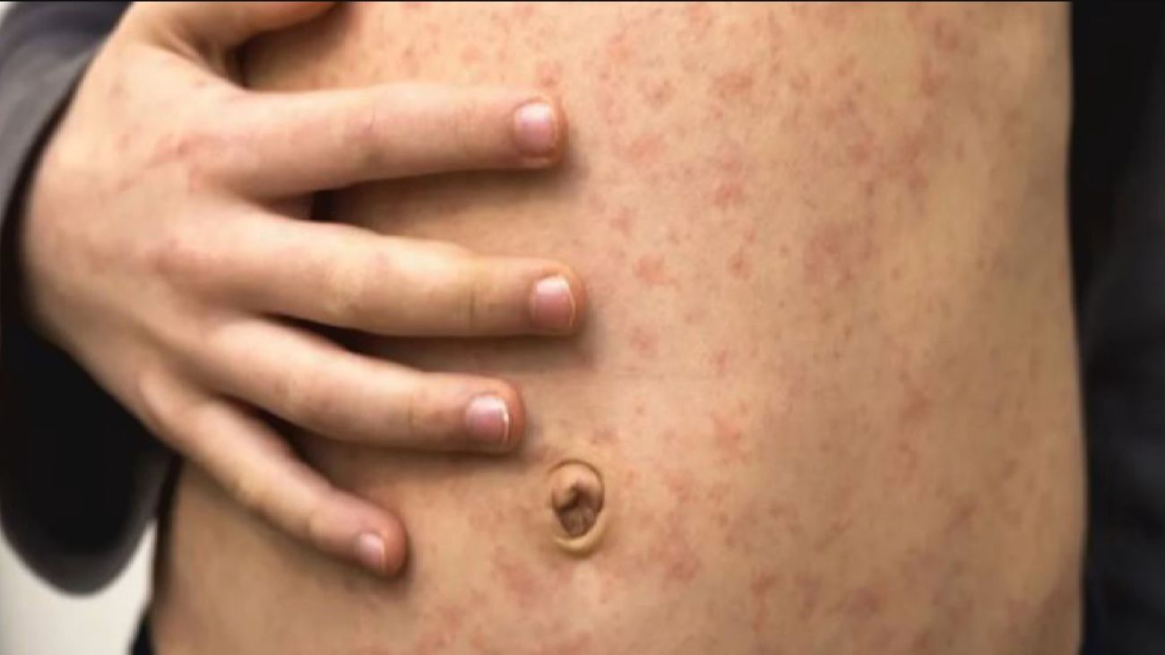 Primer caso de viruela del mono en una mujer en Madrid