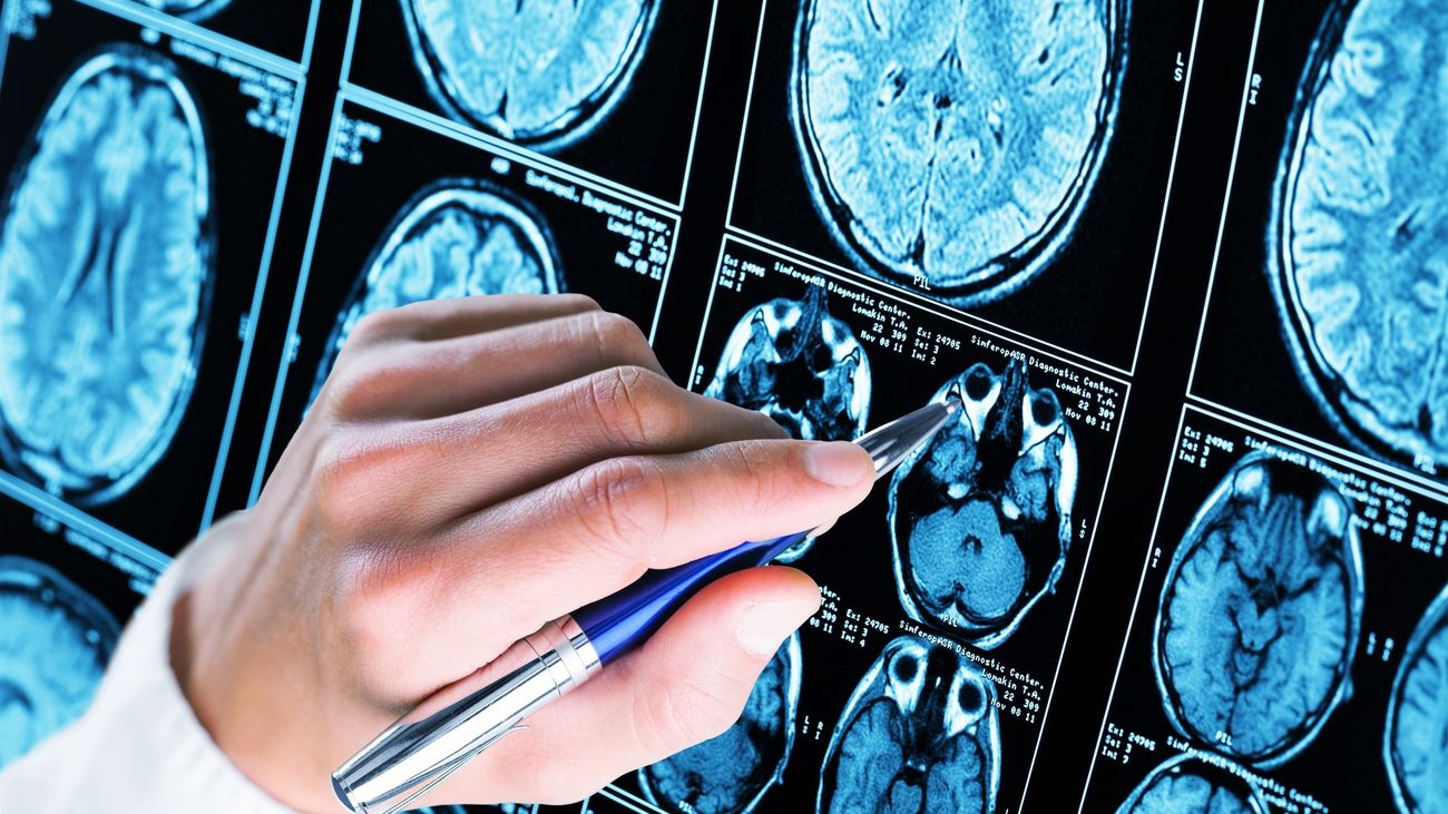 El Hospital 12 Octubre de Madrid halla una proteína que ralentiza el deterioro cerebral en casos de Alzheimer