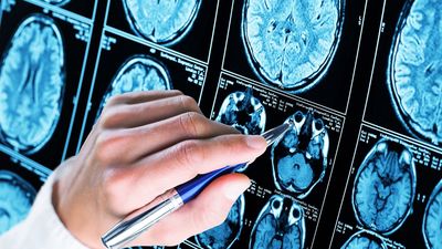 Una nueva resonancia podría anticipar enfermedades como el Párkinson o el Alzhéimer