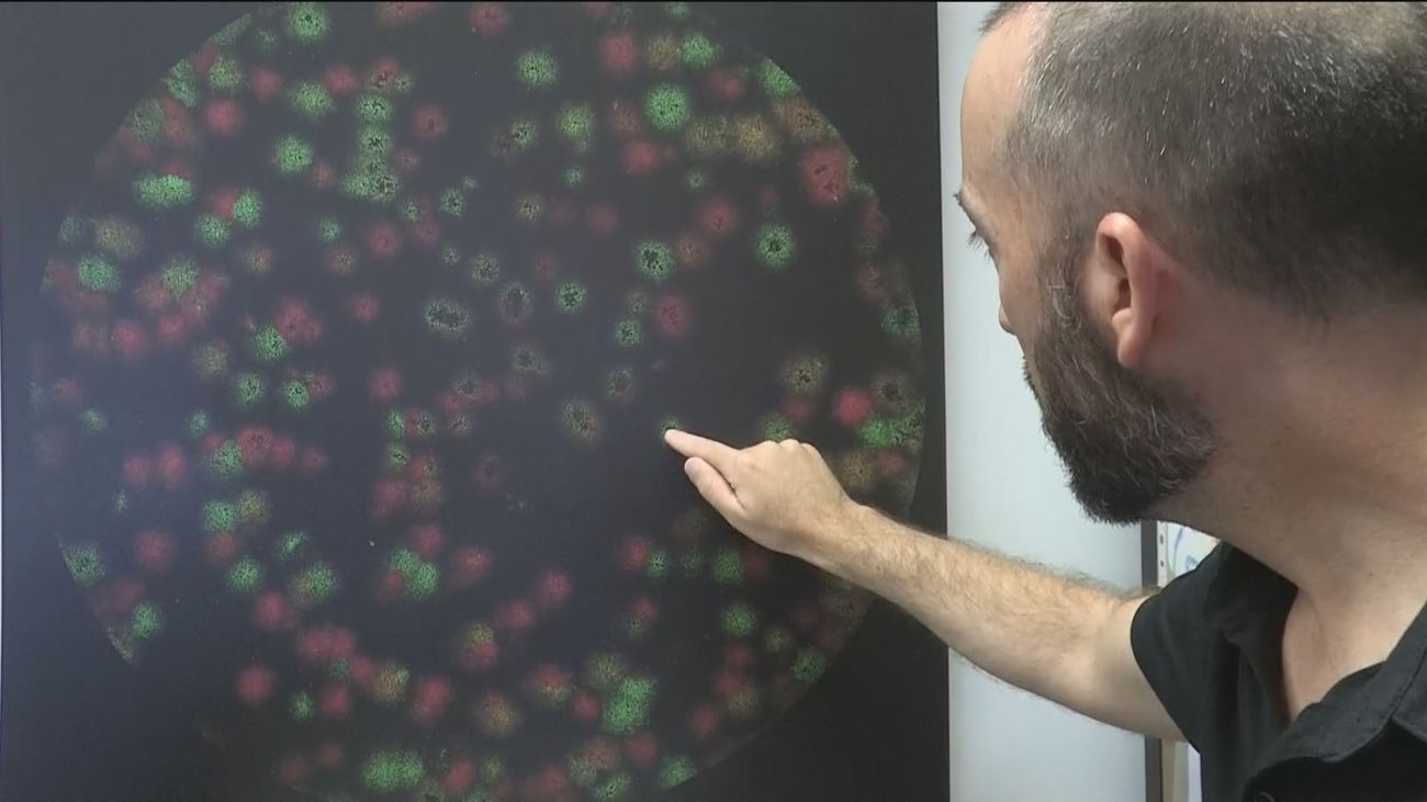 La OMS cree que la viruela del mono circuló algún tiempo sin ser detectada