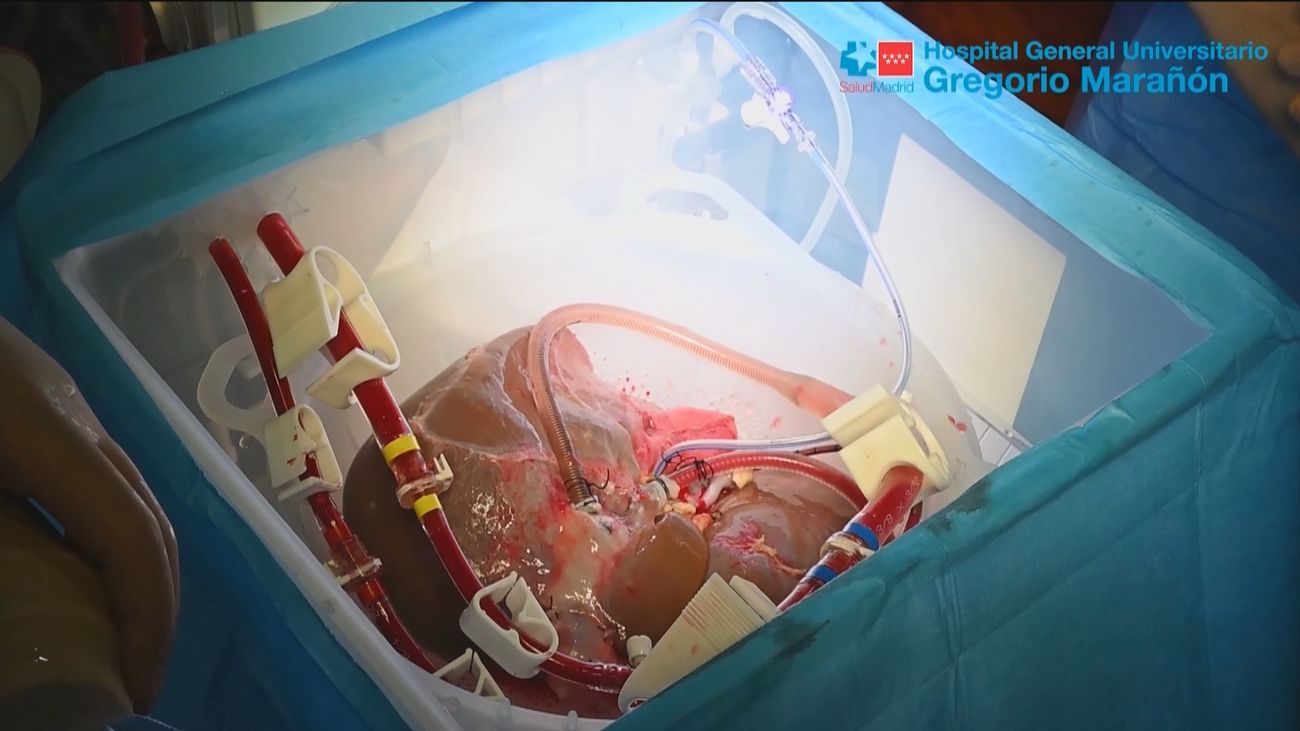 Consiguen conservar un hígado humano 3 días fuera del cuerpo y trasplantarlo posteriormente