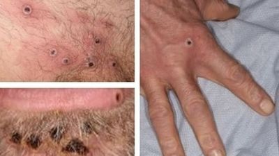 Los casos de viruela del mono en Madrid se elevan a 331 tras sumar 35 nuevos positivos