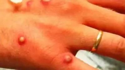 Madrid denuncia las trabas de Sanidad para recibir la vacuna de la viruela del mono