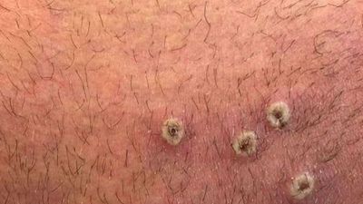 Madrid acumula 413 casos de la viruela del mono con los 14 nuevos positivos