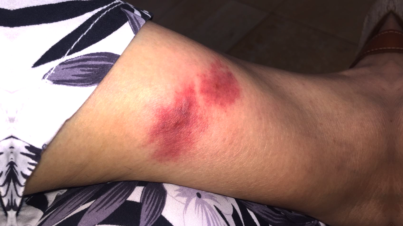 La mordedura de la mosca negra pone en jaque a los vecinos de Getafe