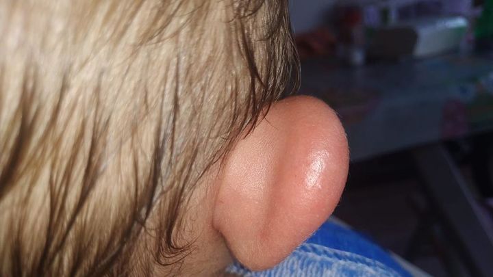 Hinchazón en la oreja de un niño de corta edad por la mordedura de mosca negra / FRAVM