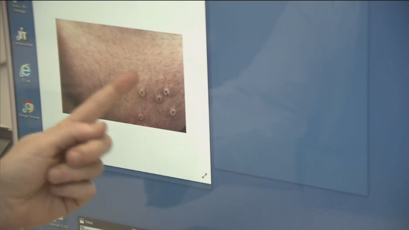 El segundo muerto por viruela del mono en España es un hombre de 31 años fallecido en Córdoba