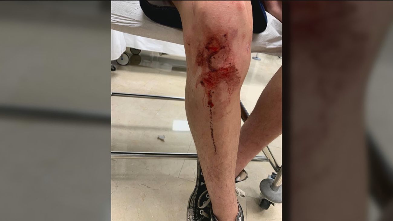 Un menor de 15 años recibe una brutal paliza al intentar proteger a su hermana en Torrelodones