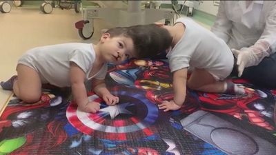 7 cirugías y más de 100 médicos: la operación que ha logrado separar a dos gemelos siameses unidos por la cabeza