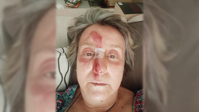 Recibe puntos en la cara tras caer en unas obras mal señalizadas de Tres Cantos