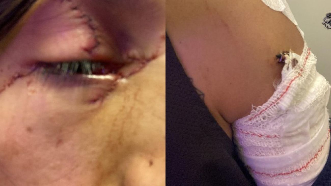Imágenes de las heridas por arma blanca de la víctima del apuñalamiento en parque de Latina