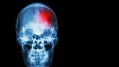 Sámur Protección Civil recuerda los 3 síntomas de un ictus por los que debes llamar a Emergencias