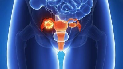 Un estudio mundial confirma la efectividad de un medicamento en pacientes con cáncer de ovario avanzado