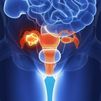 Un estudio mundial confirma la efectividad de un medicamento en pacientes con cáncer de ovario avanzado