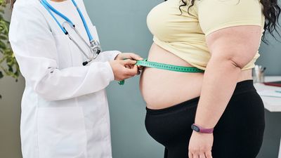 El exceso de peso se asocia con más riesgo de Covid-19 persistente