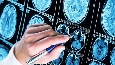 Las infecciones por covid-19 aumentan el riesgo de problemas cerebrales a largo plazo