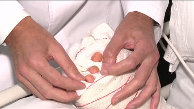 Recupera la movilidad de una mano gracias al trasplante de los dedos del pie