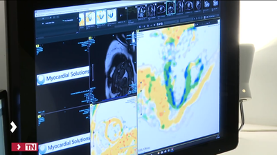 El Ramón y Cajal empleará una tecnología pionera para la prevención de enfermedades cardiacas