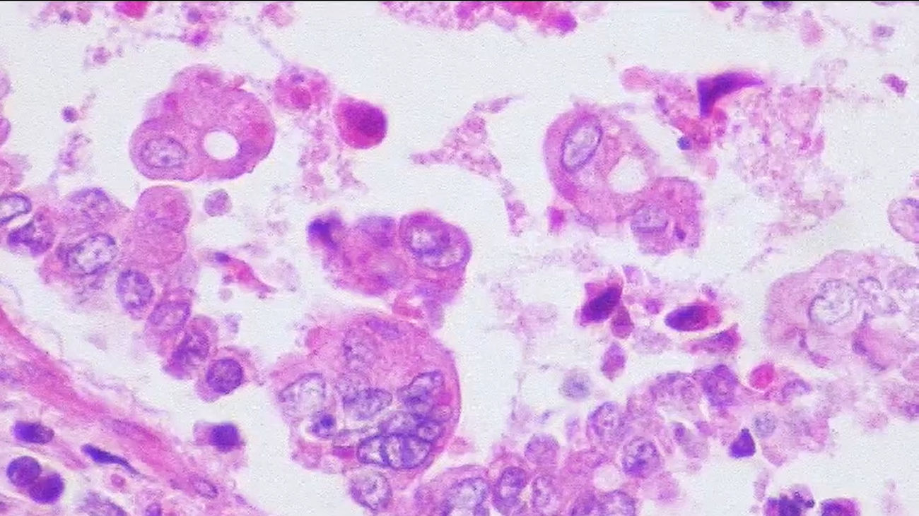 La nueva vacuna que se pondrán los bebés a partir de octubre: contra el virus VRS