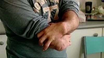 Víctimas de la talidomida acusan a Sánchez de volver a darles la espalda