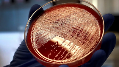 Detectados en Madrid 24 casos de estreptococo A en las últimas semanas, con 2 menores muertos y 3 en UCI