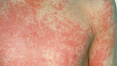 Ascienden a 19 los niños muertos en Reino Unido a causa del estreptococo A