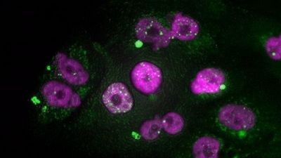 El impacto del Covid en el cáncer: Sanidad prevé más casos de pulmón, mama y colon