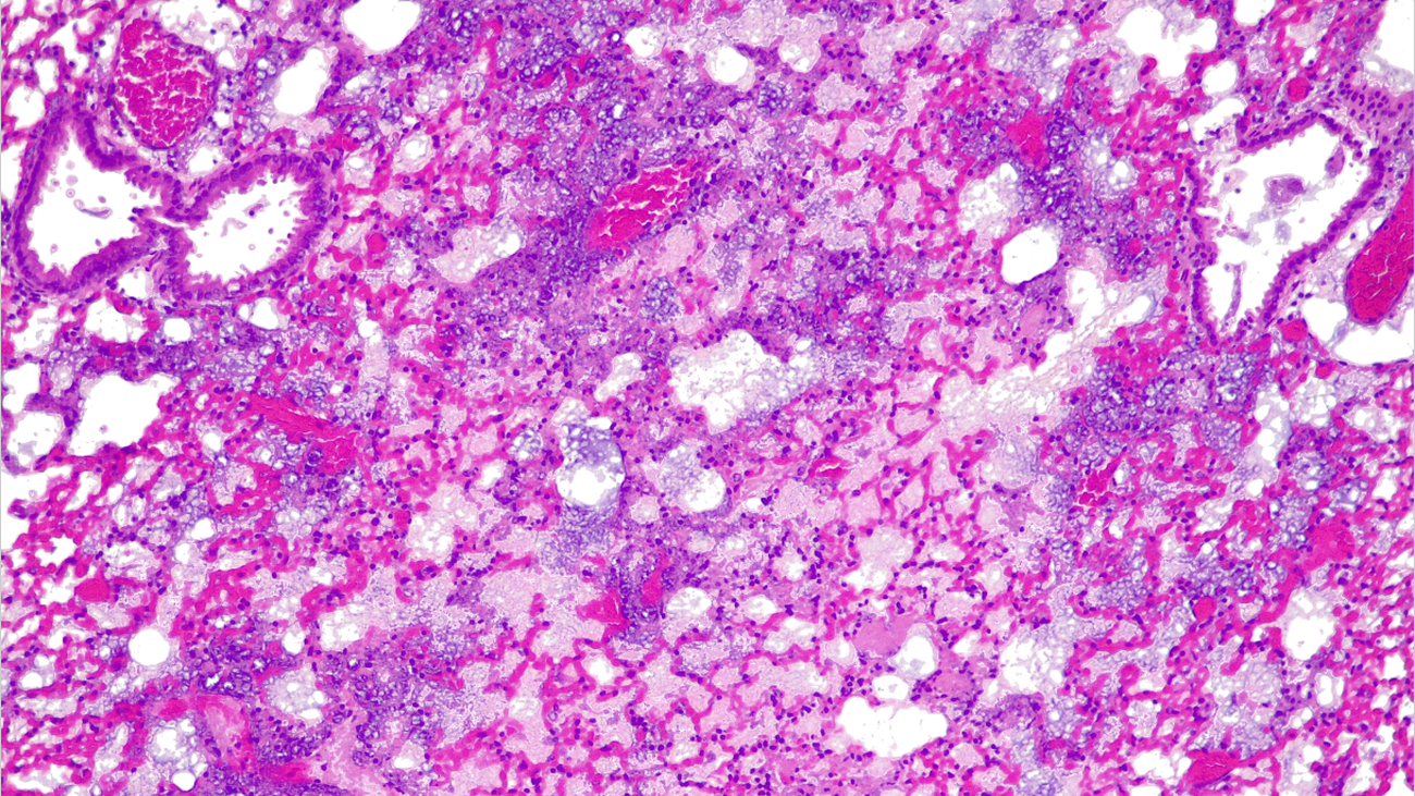 Sección transversal de un pulmón de ratón infectado por Pseudonomas aeruginosa, que provoca una neumonía grave