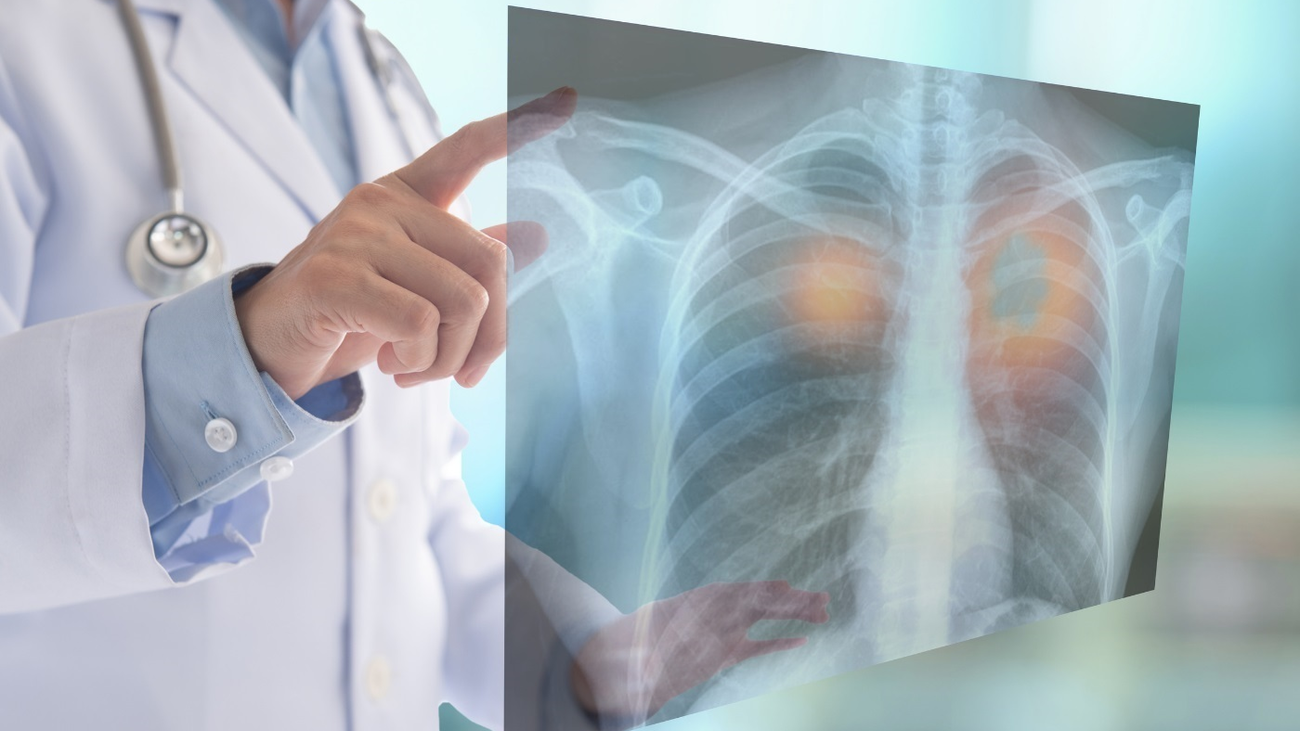 Cáncer en 2023: habrá 279.000 nuevos casos, la mayoría de colon, mama y pulmón