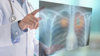 Cáncer en 2023: habrá 279.000 nuevos casos, la mayoría de colon, mama y pulmón