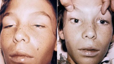 ¿Qué es el botulismo y cuáles son sus síntomas?