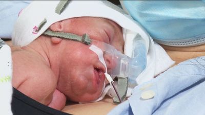 El Hospital Gregorio Marañón realiza una operación pionera de corazón a una bebé prematura de 800 gramos