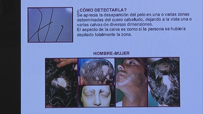 La alopecia y sus causas: una guía sobre los tipos y tratamientos por Madrid Mejora Tu Vida