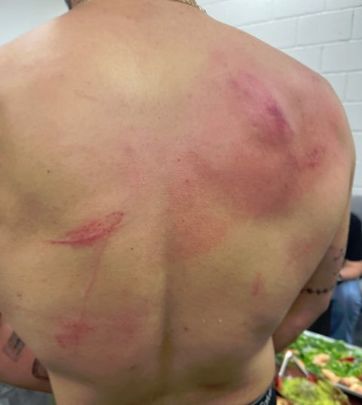 Arañazos y hematomas en la espalda de Bad Bunny / INSTAGRAM DE BAD BUNNY