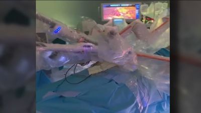 El hospital de Sanchinarro logra una doble cirugía robótica pionera en el mundo