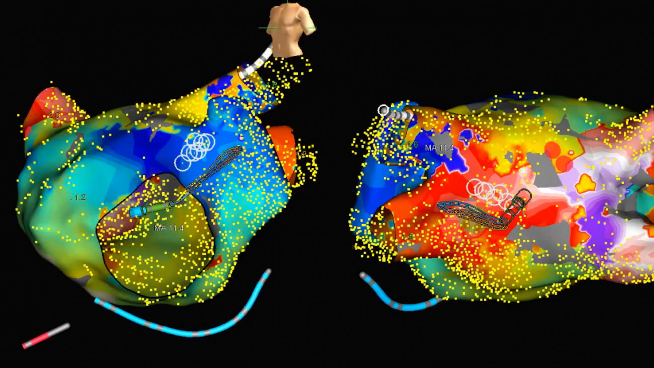 Ablación de arritmias